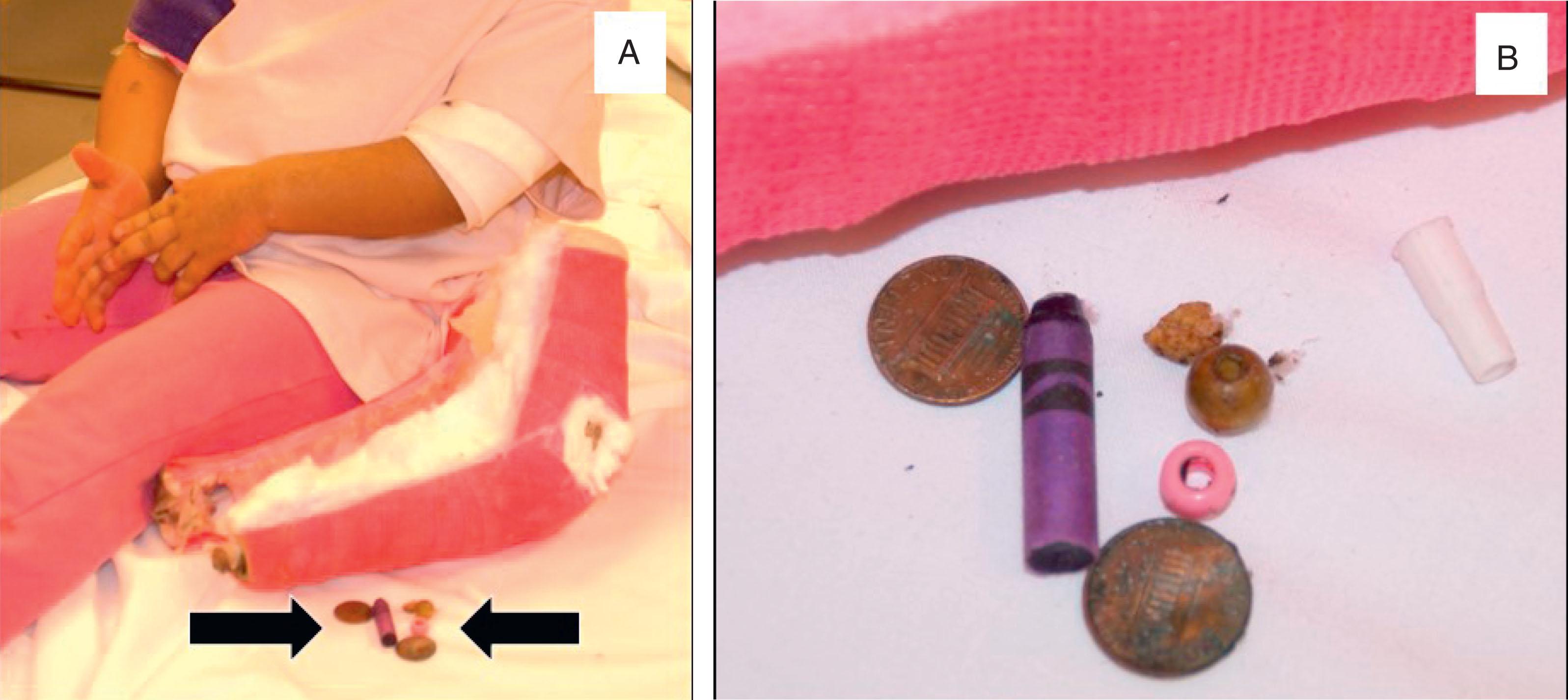 Fig. 6.4, Patient Behavioral Cast Complication. (A) School-age child with recently removed above-elbow cast. Solid arrows indicate foreign bodies that were inside her cast. (B) Close-up photo of seven small items that the child had inserted into her cast.