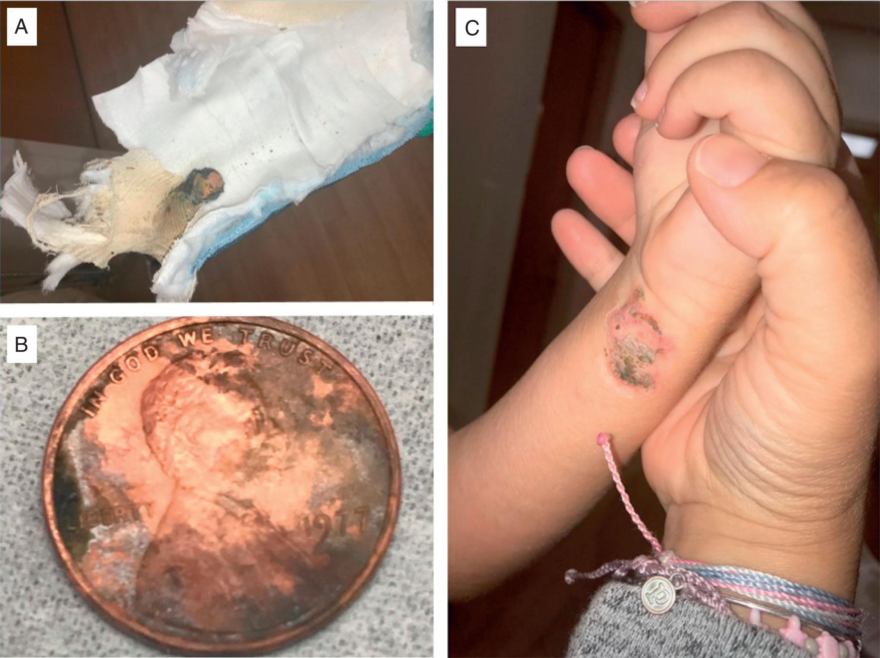 Fig. 6.5, Do not use a Cast as a Piggy Bank. (A) Patient has picked away cast padding and inserted a penny at least 2 weeks ago. (B) Penny from inside the cast. 1977 Lincoln pennies were 95% copper and 5% zinc. (C) Clinical photo (mother holding the child’s arm) showing pressure injury as well as greenish oxidative reaction of copper contact with the skin.