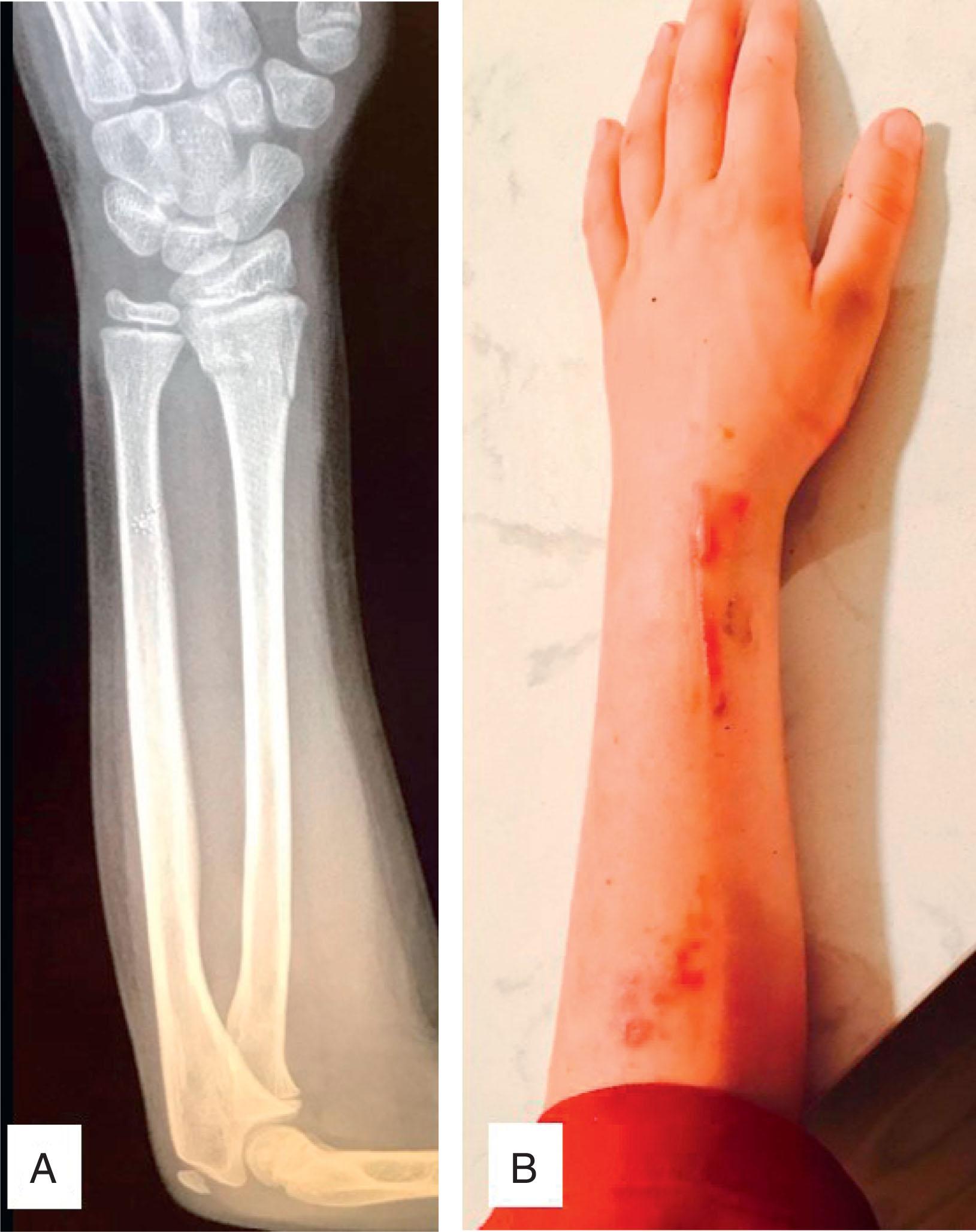 Fig. 6.6, Skin Damage From Coat Hanger Use. (A) This adolescent’s undisplaced distal radius fracture was treated with a below-elbow cotton-padded cast. (B) Self-inflicted skin damage done via repeated use of coat hanger.
