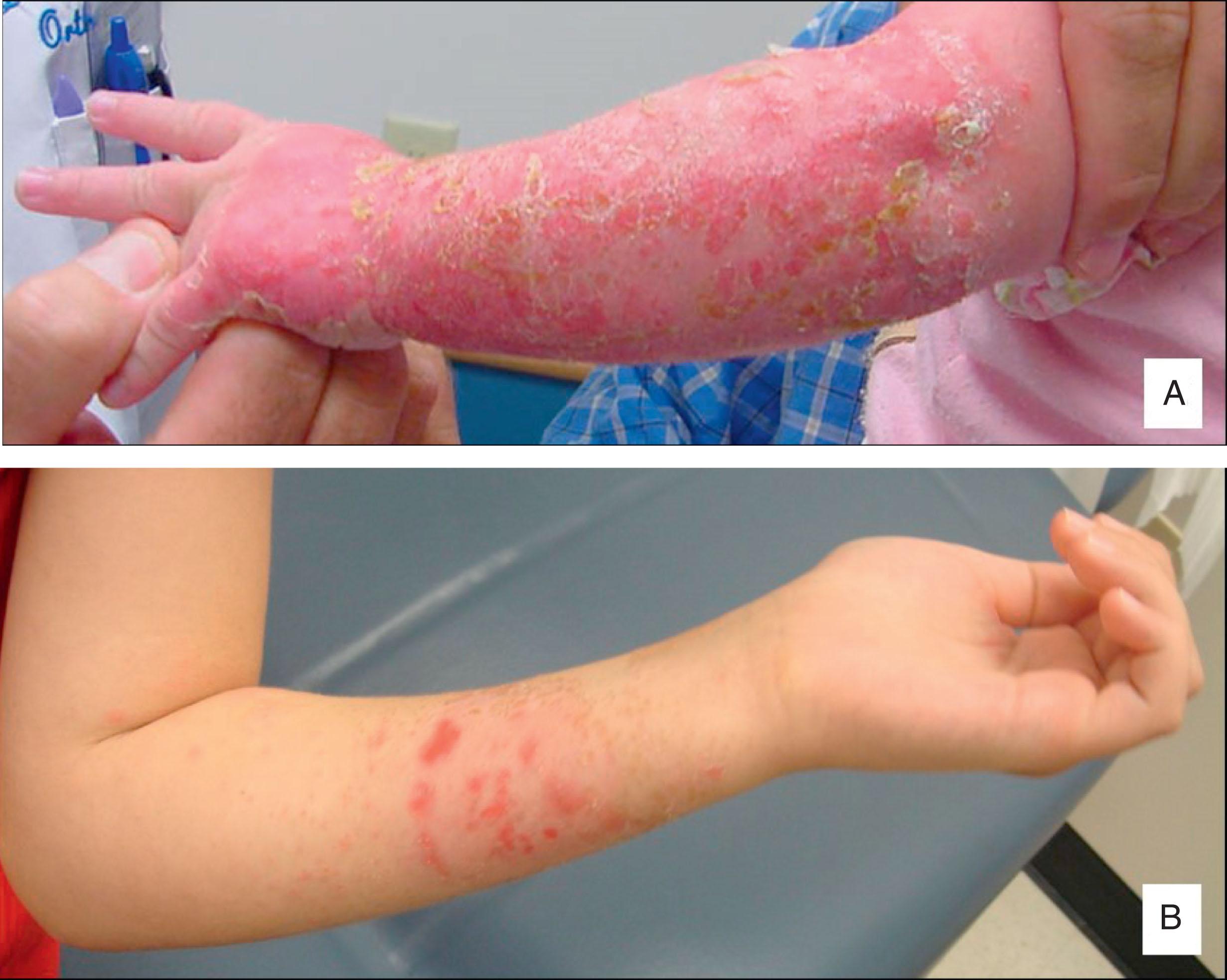 Fig. 6.9, Waterproof Cast Liner Skin Reactions. (A) Localized and minor skin reaction in a teenager. (B) Generalized and severe skin reaction in a toddler. This child was referred to the pediatric dermatology service.