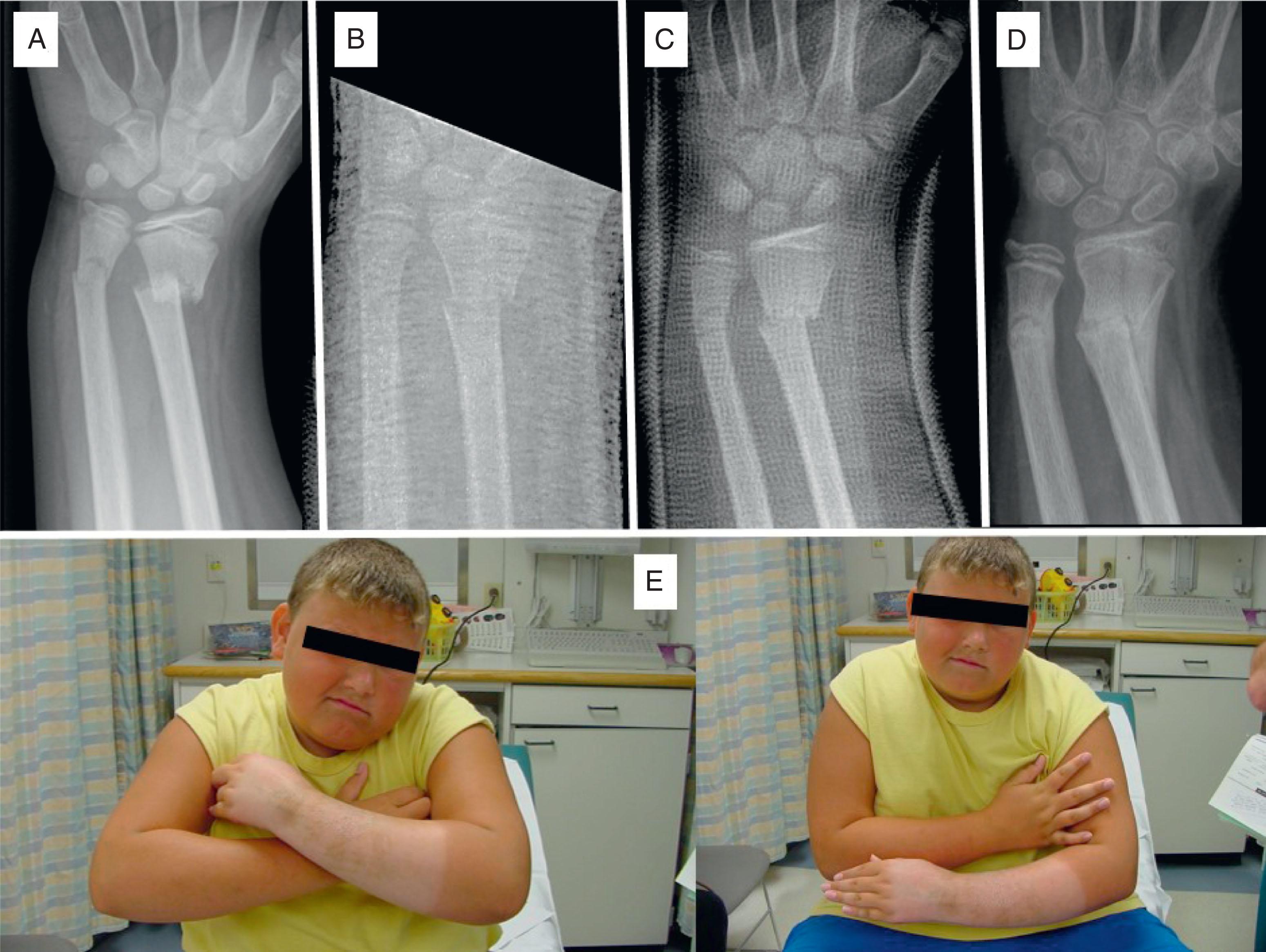 Fig. 6.10, Crooked Cast Leads to Crooked Wrist and Unhappy Patient and Family. (A) An 11-years-and-11-months–old male with completely displaced metaphyseal radius and relatively intact ulna. (B) Initial reduction was satisfactory. (C) Converted at 2 weeks to improperly molded (radial deviation) cast. (D) At 6 weeks the coronal alignment of the healed fracture is exactly congruent with prior cast position. (E) Clinical photos of unhappy patient.