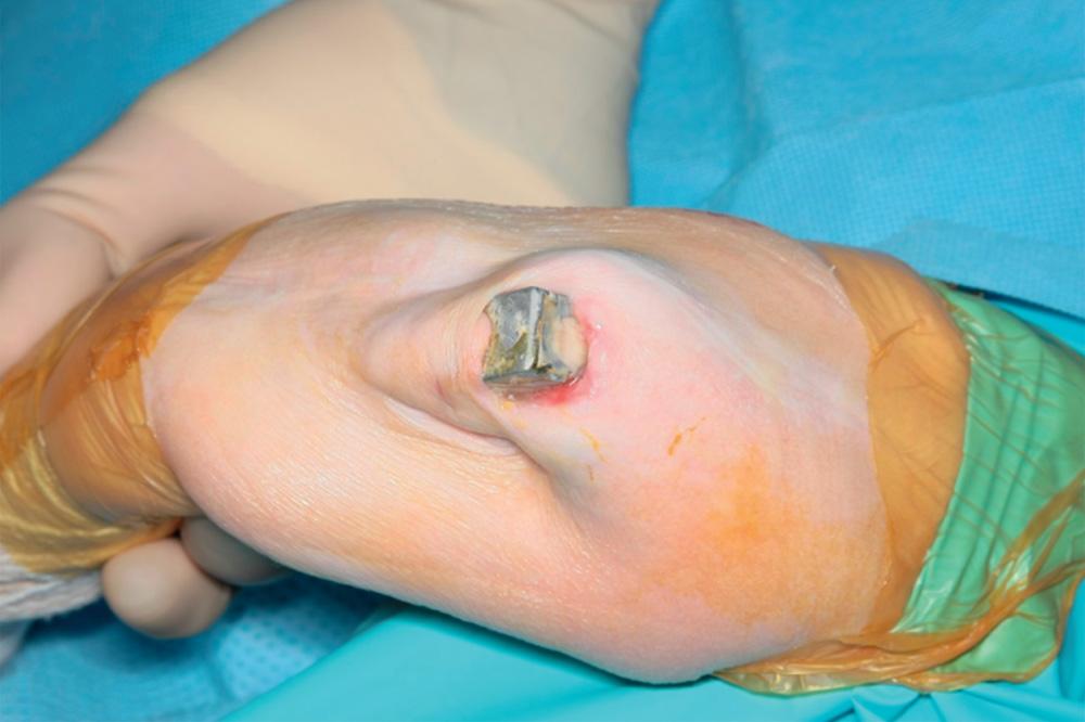 FIG 99.1, The subcutaneous nature of the joint makes the elbow vulnerable to wound complications, even years after implantation.