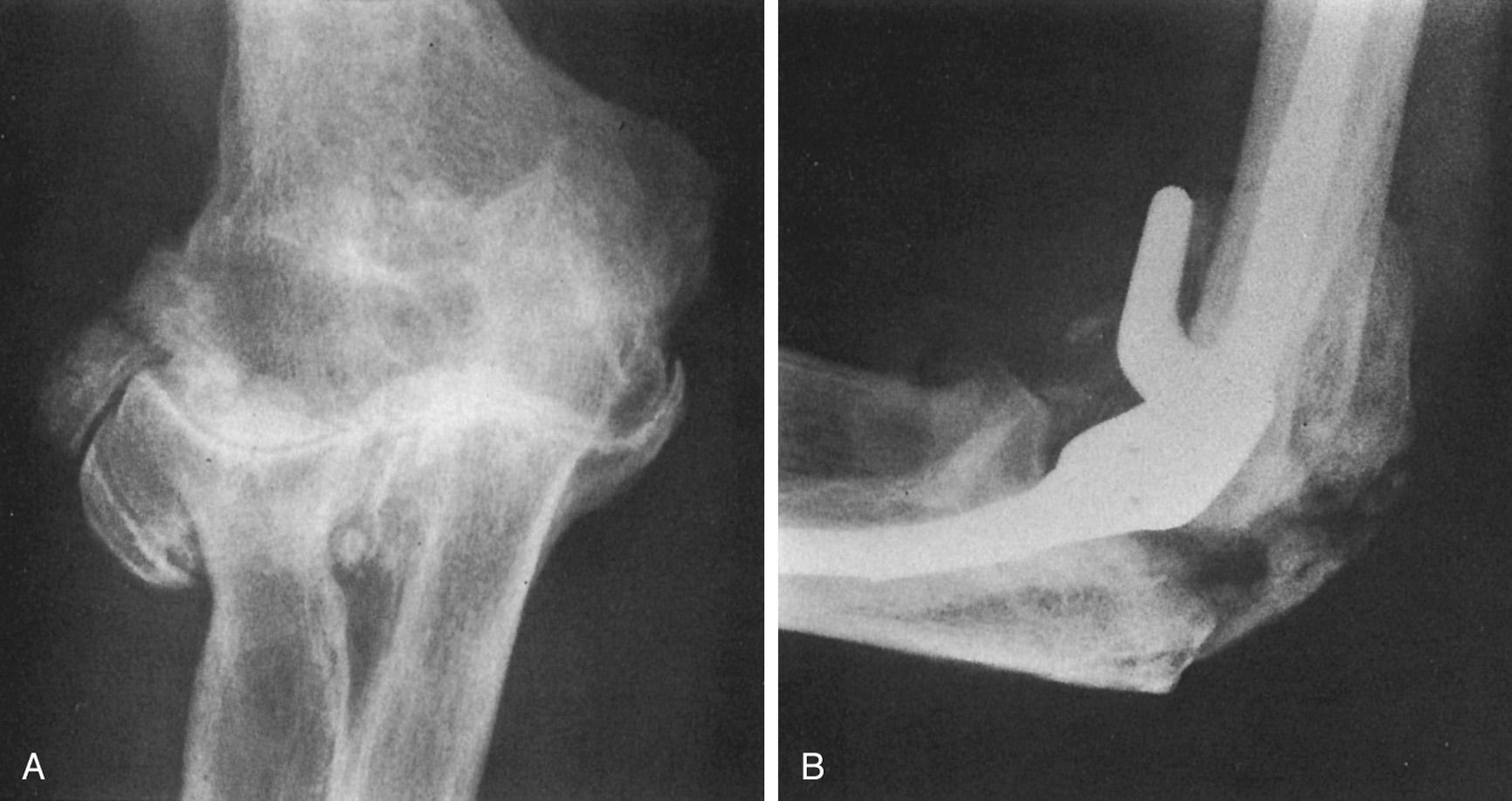 FIG 99.2, A patient with hypertrophic osteoarthritis and motion from 60 to 90 degrees before surgery (A) developed marked hematoma and significant posterior ectopic bone (B).