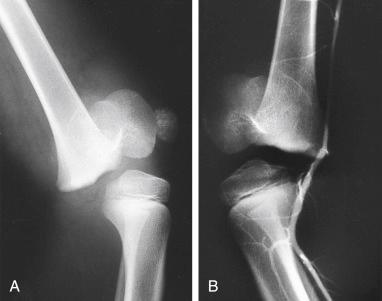 Fig. 7.1, (A) Supracondylar fracture of the femur in an 8-year-old boy with complete displacement of the distal femoral epiphysis. Decreased pulses and this fracture pattern are suggestive of a vascular injury. (B) An arteriogram demonstrates attenuation of the popliteal artery, but it is still intact. The fracture was reduced and fixed with crossed pins; subsequent premature growth arrest occurred.