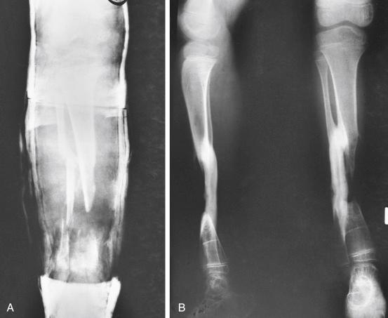 Fig. 7.11, (A) Nonunion of the tibia after a lawn mower injury with extensive soft tissue loss and infection. (B) After the soft tissue problems and infection were resolved, adequate skin coverage was obtained, and a bone graft from the fibula to the proximal and distal ends of the tibia was performed to achieve stability of the leg.