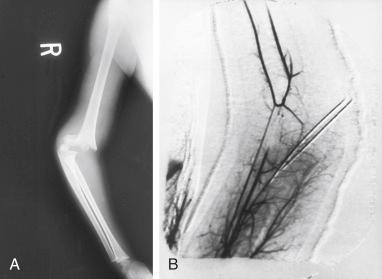 Fig. 7.2, (A) Supracondylar fracture of the humerus in a 7-year-old patient with absent pulses despite satisfactory reduction and pinning. (B) Arteriogram demonstrating good collateral circulation but a complete block of the brachial artery. The artery was explored, an intimal flap was found and resected, and a successful end-to-end anastomosis was performed.