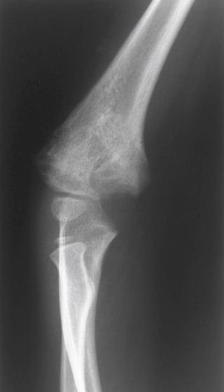 Fig. 7.4, A 4-year-old patient with a supracondylar fracture of the humerus that healed with a cubitus varus deformity.