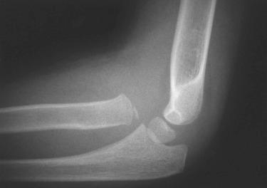 Fig. 7.5, A 6-year-old patient with a Monteggia fracture. Note the anterior dislocation of the radiocapitellar joint.