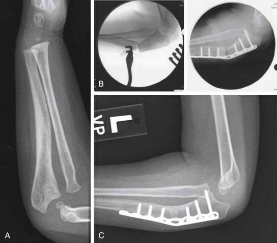 Fig. 7.6, (A) A 6-year old with a chronic Monteggia fracture dislocation who presented with a palpable antecubital mass 6 months after a fall. Note the healed ulna fracture with apex anterior angulation. (B) Intraoperative films following a proximal ulna elongation osteotomy to allow for reduction of the radial head with plate fixation. (C) Congruency of the radiocapitellar joint remains well aligned following healing of the osteotomy.