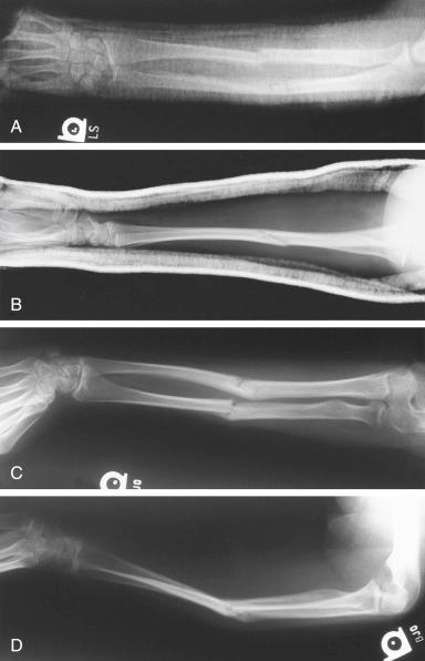 Fig. 7.7, Fracture of the radius and ulna in a 12-year-old girl. Anteroposterior (A) and lateral (B) views of the injury after satisfactory reduction and cast immobilization. (C and D) Fracture reduction was lost because of early removal of the cast, and open reduction plus plate fixation was required to restore satisfactory alignment. In a girl of this age, spontaneous correction cannot be expected.