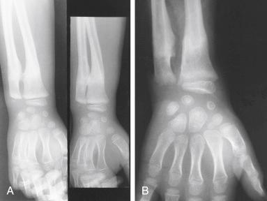 Fig. 7.10, (A) Anteroposterior and oblique views of the distal end of the forearm and wrist of a 7-year-old boy who sustained a fracture of both bones of the forearm. The fracture healed in a malrotated and angulated position with subsequent synostosis that is easily seen on the oblique view. (B) The traumatic synostosis was resected with interposition of fat. Preoperatively, the patient had no forearm rotation; postoperatively, he regained 50 degrees of forearm rotation.