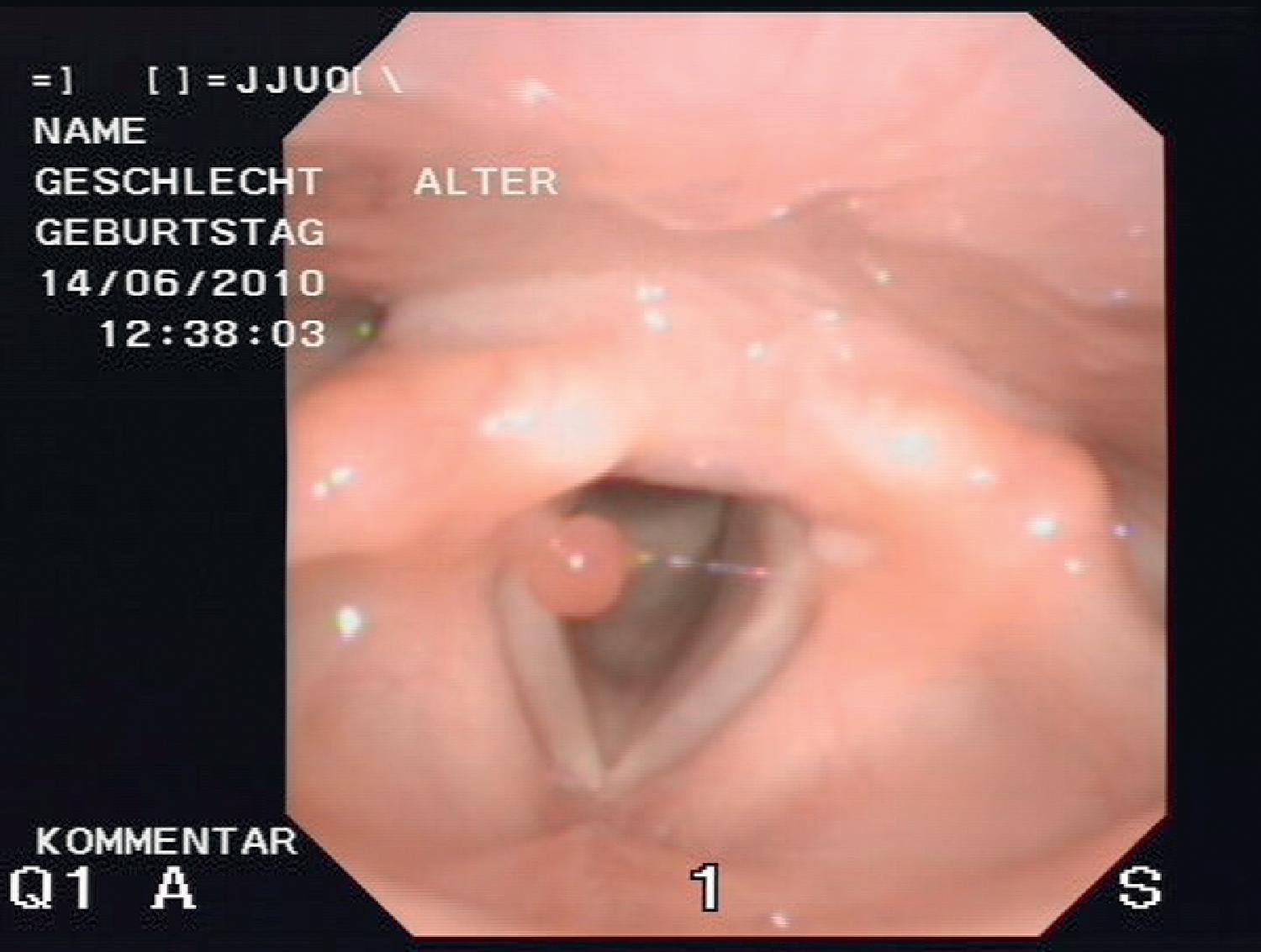 Fig. 48.1, Granuloma on the anterior aspect of the left vocal cord after endotracheal intubation.