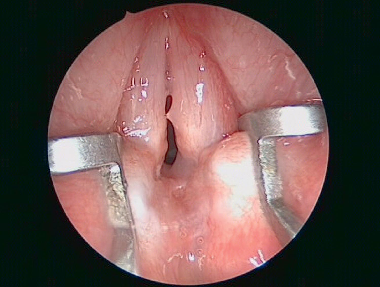 Fig. 48.3, Interarytenoid fibrosis after intubation. A fibrotic lesion has developed between the arytenoid cartilages after prolonged intubation.