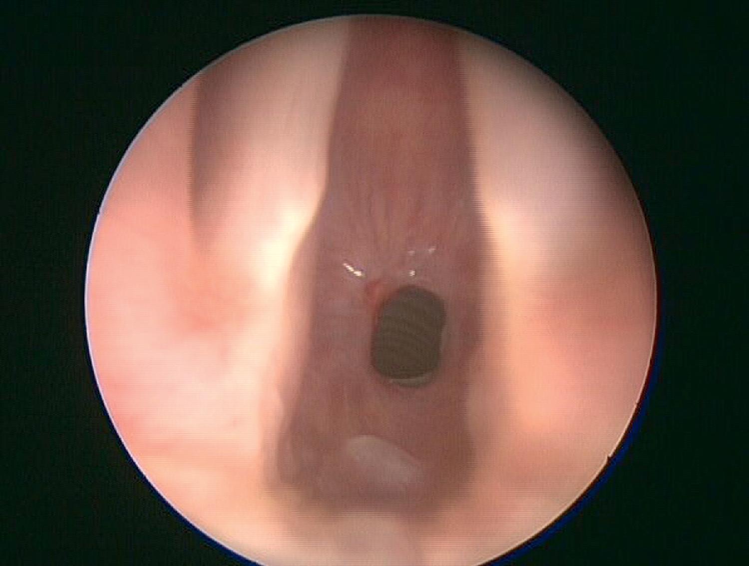 Fig. 48.4, Subglottic stenosis. An endotracheal view through the vocal cords shows subglottic stenosis after long-term intubation.