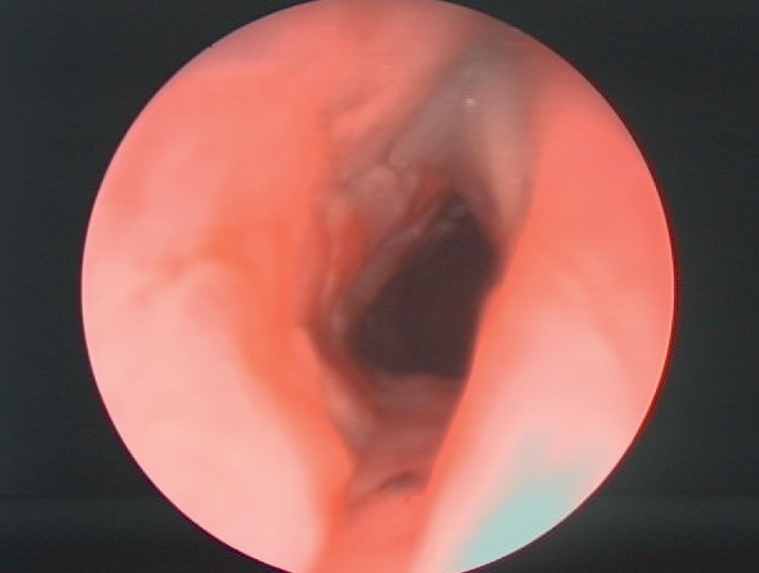 Fig. 48.5, Ulcerative lesion in the area of the left vocal cord after long-term intubation.