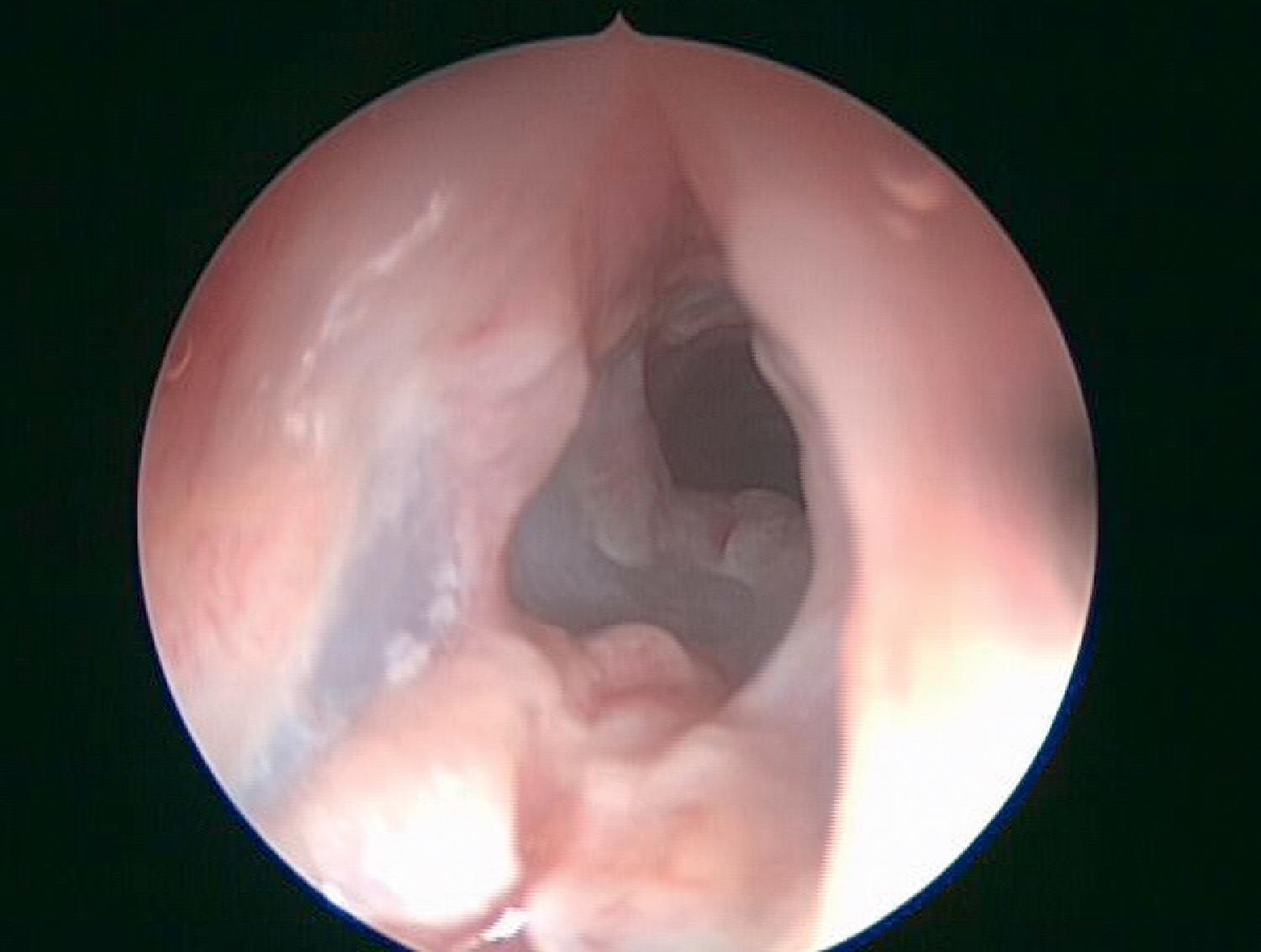 Fig. 48.6, An endotracheal view shows avulsion of the mucous membranes caused by wrapping of the endotracheal tube with stimulation electrodes for neurosurgery in a 2-year-old child.