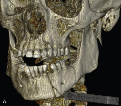 Fig. 1.16.1, The “OIF” – rigid fixation with failure to reduce. (A–B) 3D CTs of severe, displaced, fractures of the right ramus, left parasymphysis, and left subcondyle. (C) 3D CT of the malreduction. Note marked flaring of the right angle and obvious crossbite on the right.