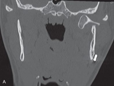 Fig. 1.16.2, Malreduction of a displaced condylar fracture. (A) CT of displaced condylar fracture. (B) CT and panoramic view demonstrating malreduction. (C) Panoramic X-ray of OIF.