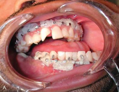 Fig. 1.16.3, A 31-year-old man 3 weeks status post gunshot wound to the face. He had significant hemorrhage and required embolization of his lingual arteries. Arch bars were applied following OIF of his symphysis, planning to reduce the bilateral angle fractures closed. It was not possible to bring his teeth into occlusion with elastics so he was referred for definitive treatment. (A) X-ray demonstrating presenting occlusion. (B) Panoramic X-ray. Note coils from embolization. Molds of his teeth were made, sectioned, and reassembled into correct occlusion. A splint was fabricated. (C) Mounted, sectioned models with splint. (D) Fractures exposed through neck. Note OIF of symphysis fracture. The left angle was draining pus. (E) Acrylic splint fixed to mandibular teeth confirming correct alignment. (F) Fractures fixed with locking reconstruction plate. (G) Maxillomandibular fixation placed. (H) Postoperative X-ray. (I) Postoperative occlusion. Note slight anterior open-bite later corrected with a Le Fort I osteotomy.