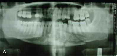 Fig. 1.16.4, Comminuted parasymphysis fracture inadequately managed with a combination of miniplates and a 2.0 locking plate. (A) Preoperative panoramic X-ray. (B) Post reduction panoramic X-ray. (C) Debrided failed fixation, bone, and teeth. (D) Postoperative panoramic X-ray.