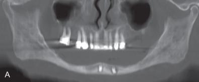 Fig. 1.16.6, A 71-year-old man with pathological fracture of his atrophic mandible secondary to failing dental implants. The treatment plan called for removal of the implants, RIF of the mandible with a 2.0 locking plate, bone graft, and new implants through a transoral approach. (A) Atrophic mandible. (B) Exposure of failing implants. (C) Application of 2.0 plate, implants, and particulate bone graft. (D) Panoramic radiograph. (E) Wound breakdown at 2 weeks. (F) Fracture of plate at 6 weeks. (G) Plate removed, external fixator applied. (H) Following healing of oral wound, external fixator removed and larger locking reconstruction plate applied through neck with additional bone graft. (I) 3D CT. Note dental implants still in place and functional. (J) Four years later, patient returns with exposed plate intraorally. (K) Plate further exposed surgically, sectioned on either side, and removed. (L) Post-removal X-ray.