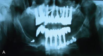 Fig. 1.16.7, Bilateral condylar and parasymphyseal fracture in man with full-mouth implant rehabilitation managed with MMF screws and locking miniplate for parasymphyseal fracture. Parasymphysis plate failed with loss of the dental implant. (A) Image of failing construct. (B) Simplification with inferior border miniplate. (C) Locking reconstruction plate and tibial bone graft. (D) Image of construct. (E) Patient returns 4 years later with exposed hardware. (F) Plate removed, nonunion discovered. (G) Locking reconstruction plate placed over inferior border to allow closure. (H) Image of construct.