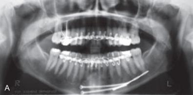 Fig. 1.16.8, Surgical misadventures. (A) Broken drill in mandibular medullary spaces lost during attempted lag screw placement. (B) Tooth root pithed and fractured during attempted screw placement. (C) MMF screws placed into tooth roots. (D) Root pithed from MMF screw.