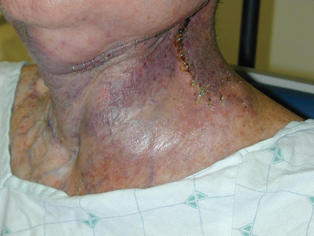 Fig. 119.1, Seroma formation after modified radical neck dissection following prior radiation therapy.