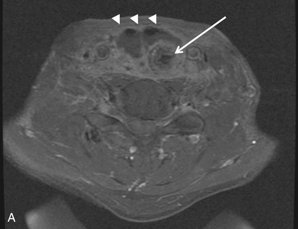 Fig. 119.2, Magnetic resonance imaging of a pharyngocutaneous fistula after total laryngopharyngectomy, cervical esophagectomy, and tubed radial forearm free flap reconstruction (arrow) for hypopharyngeal cancer. (A) Axial T1 gadolinium-enhanced image with fat saturation showing fluid and air (arrowheads) anterior to the proximal, pharyngeal anastomosis. (B) Sagittal (midline) T2 image with fat saturation demonstrating the same fluid and air collection anterior to the free flap with no direct communication to the laryngostoma (x).