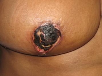 Fig. 17.3, Full thickness necrosis of the nipple–areolar complex is an uncommon complication but can occur with wide undermining and devascularization.