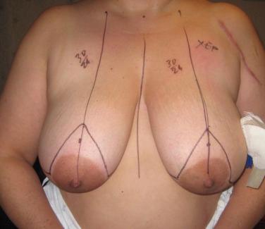 Fig. 17.10, The preoperative marking before oncoplastic reduction mammaplasty.