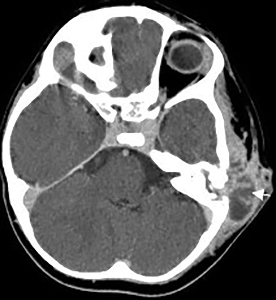 Fig. 40.1, Axial CT scan with contrast demonstrating a postauricular abscess.