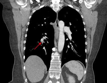 Fig. 16.1, Spiral computed tomography image of the chest with intravenous contrast showing an acute pulmonary embolism (arrow) in the thrombus in the segmental branches of the right lobe of the pulmonary artery.