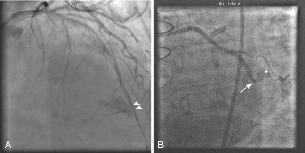 Fig. 29.5, Coronary perforations.