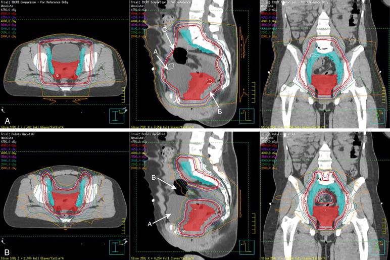 Fig. 23.1, Comparison Between Intensity-Modulated Radiotherapy (IMRT) and Three-Dimensional Conformal Plans.