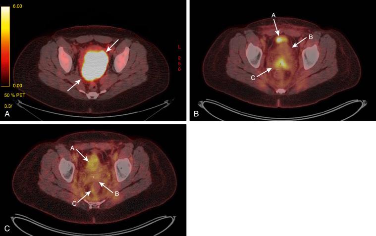 Fig. 23.4, Cervical Necrosis.