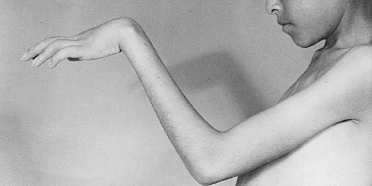 FIG 28.5, Volkmann's ischemic contracture of the forearm. The residual of an untreated forearm compartment syndrome in an 8-year-old boy.