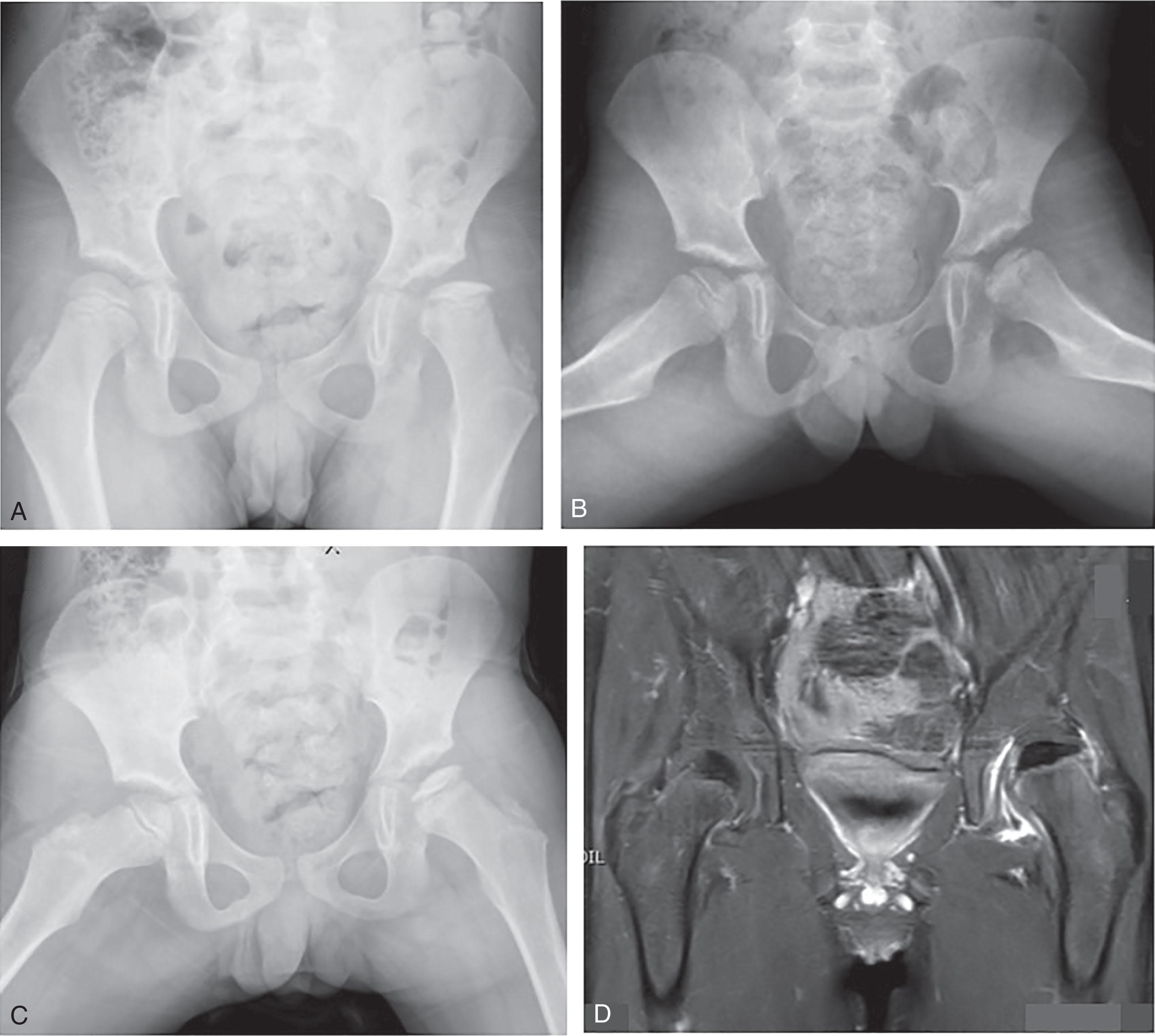 Fig. 30.1, A 6-Year-Old Male With Legg-Calve-Perthes Disease. (A) Anteroposterior view. (B) Frog lateral view. (C) Maximum abduction view. (D) Perfusion magnetic resonance imaging coronal view.