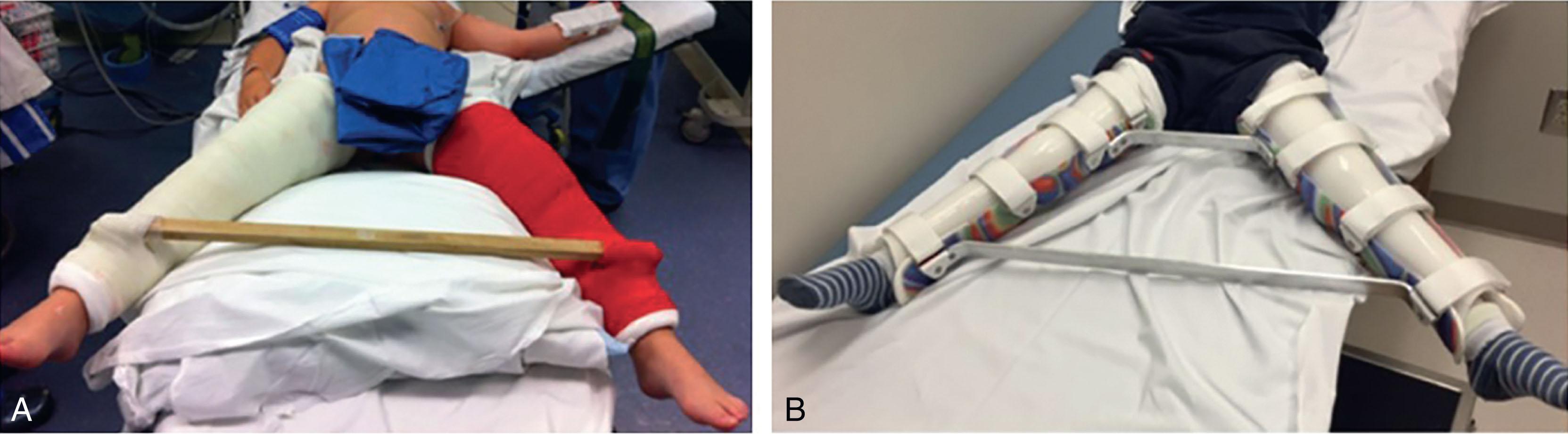 Fig. 30.2, (A) Petrie cast with removable bar. (B) Custom made A-frame style rigid abduction orthosis. (All images are reproduced with permission from Wudbhav N. Sankar, MD.)