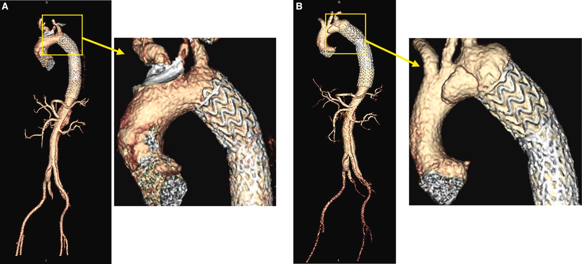 Fig. 20.3, Antegrade dissection in a patient who underwent endovascular repair of Type B aortic dissection because of poor angulation. CT angiogram of the chest (A) 1 month and (B) 8 months after surgery.