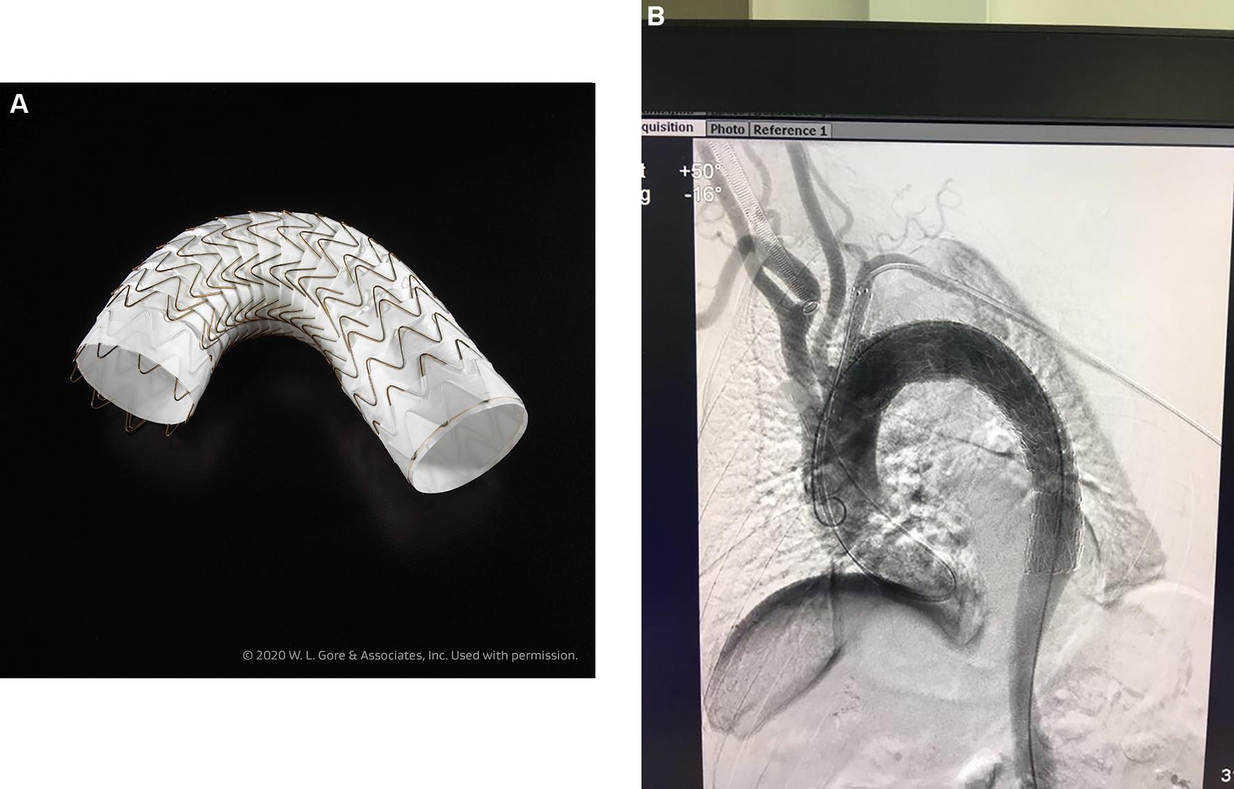 Fig. 20.4, (A) Gore Conformable TAG (CTAG) endoprosthesis; (B) Aortogram during placement of CTAG endograft and left subclavian stent graft for endovascular repair of acute Type B aortic dissection. Adequate alignment of the CTAG device in a patient with Type III aortic arch.
