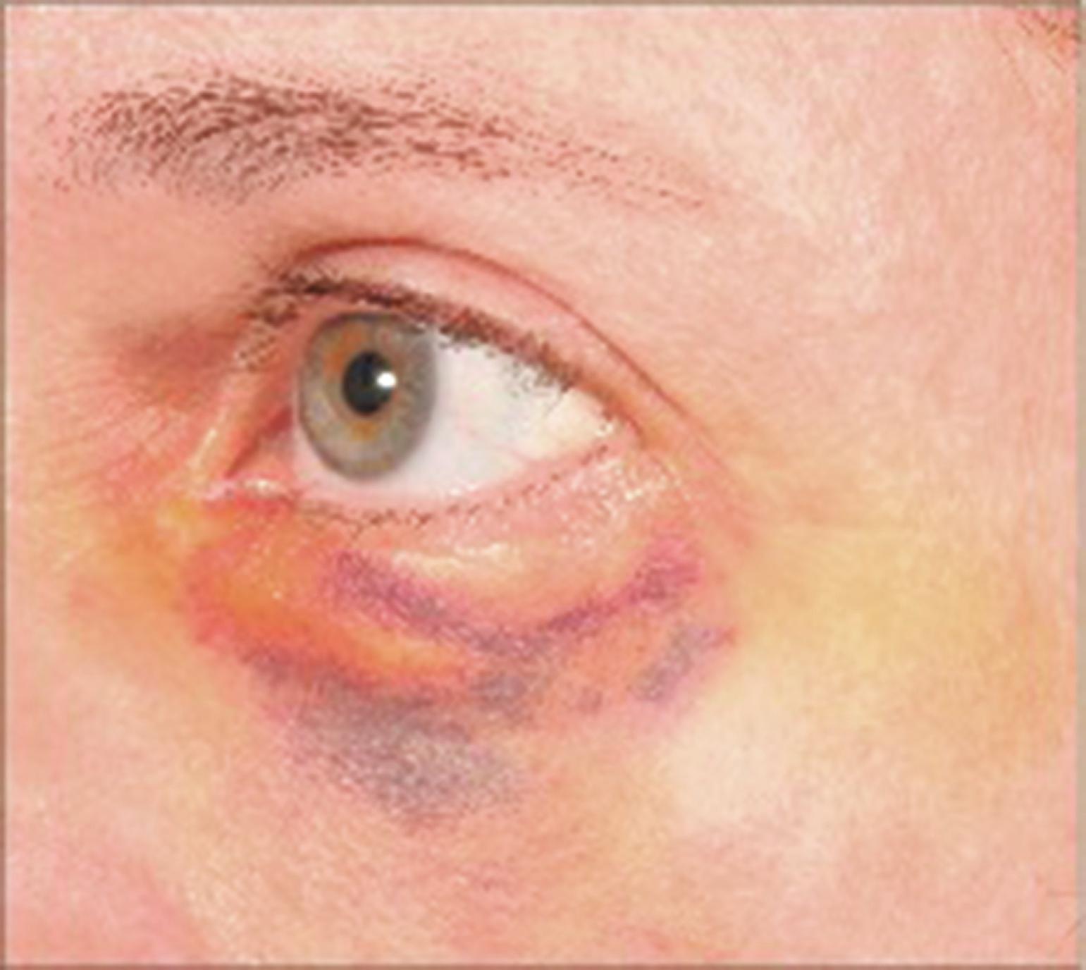 Fig. 35.1, Severe periocular ecchymosis 7 days following injection of hyaluronic acid deep into the supraperiosteal fat pads.