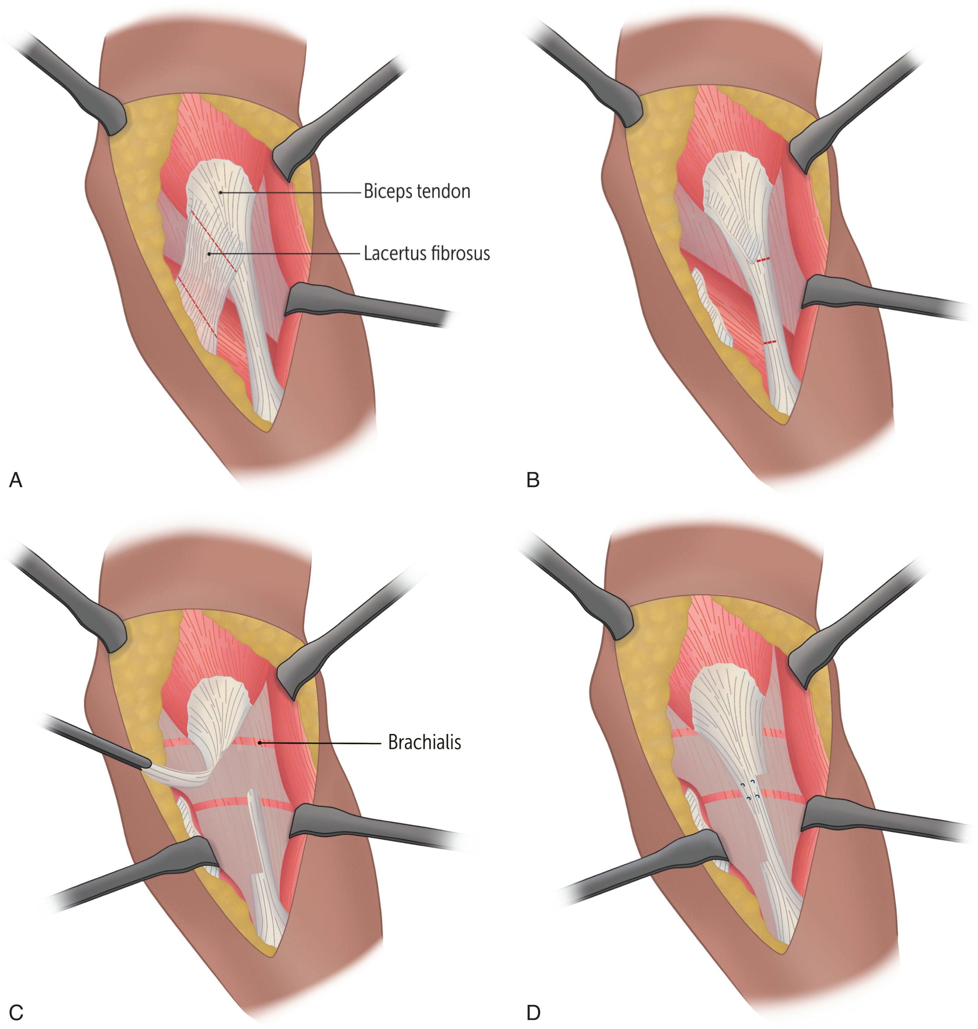 Fig. 40.2, Elbow Release. Once the curvilinear or z-plasty incision is made at the elbow, the lacertus fibrosus can be identified and divided (A) . The adventitia is removed from the distal biceps tendon, and two transverse incisions can be made approximately 3 cm apart. One incision is made on the medial half of the tendon, and the other is made on the lateral half (B) . Fractional lengthening of the brachialis muscle is performed by making two transverse incisions across the entirety of the muscle’s ribbon-like aponeurosis and then extending the elbow (C) . Extending the elbow also separates the two partial tenotomy sites of the biceps tendon. Nonabsorbable sutures are then placed in the residual biceps tendon, between the tenotomy sites, to prevent further splitting of the fibers (D) .