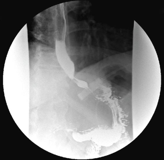 Figure 21.1, Barium meal showing band sitting at a normal angle of approximately 45 degrees, in the 8-to-2 o’clock direction.