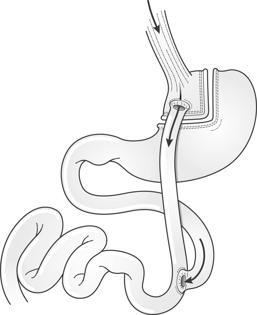 Figure 21.2, Diagram of a gastric bypass.