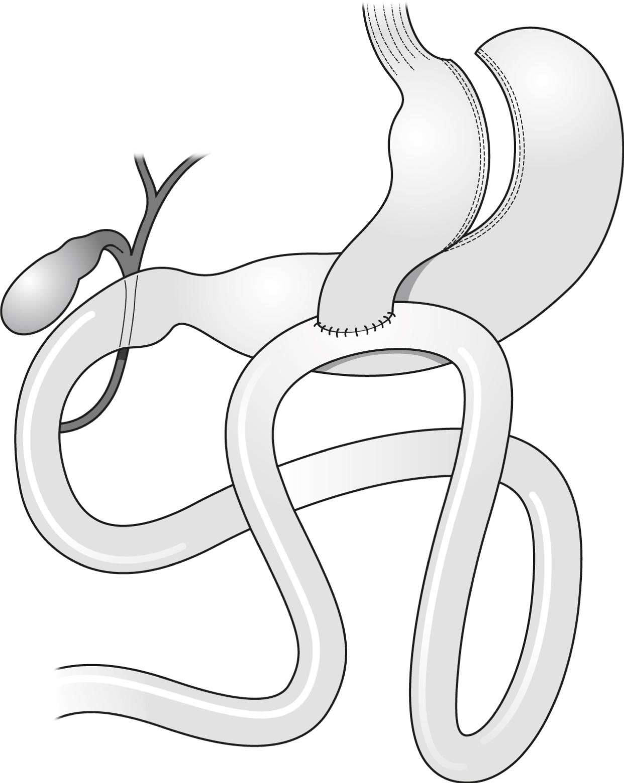 Figure 21.3, Diagram of a mini-gastric bypass.