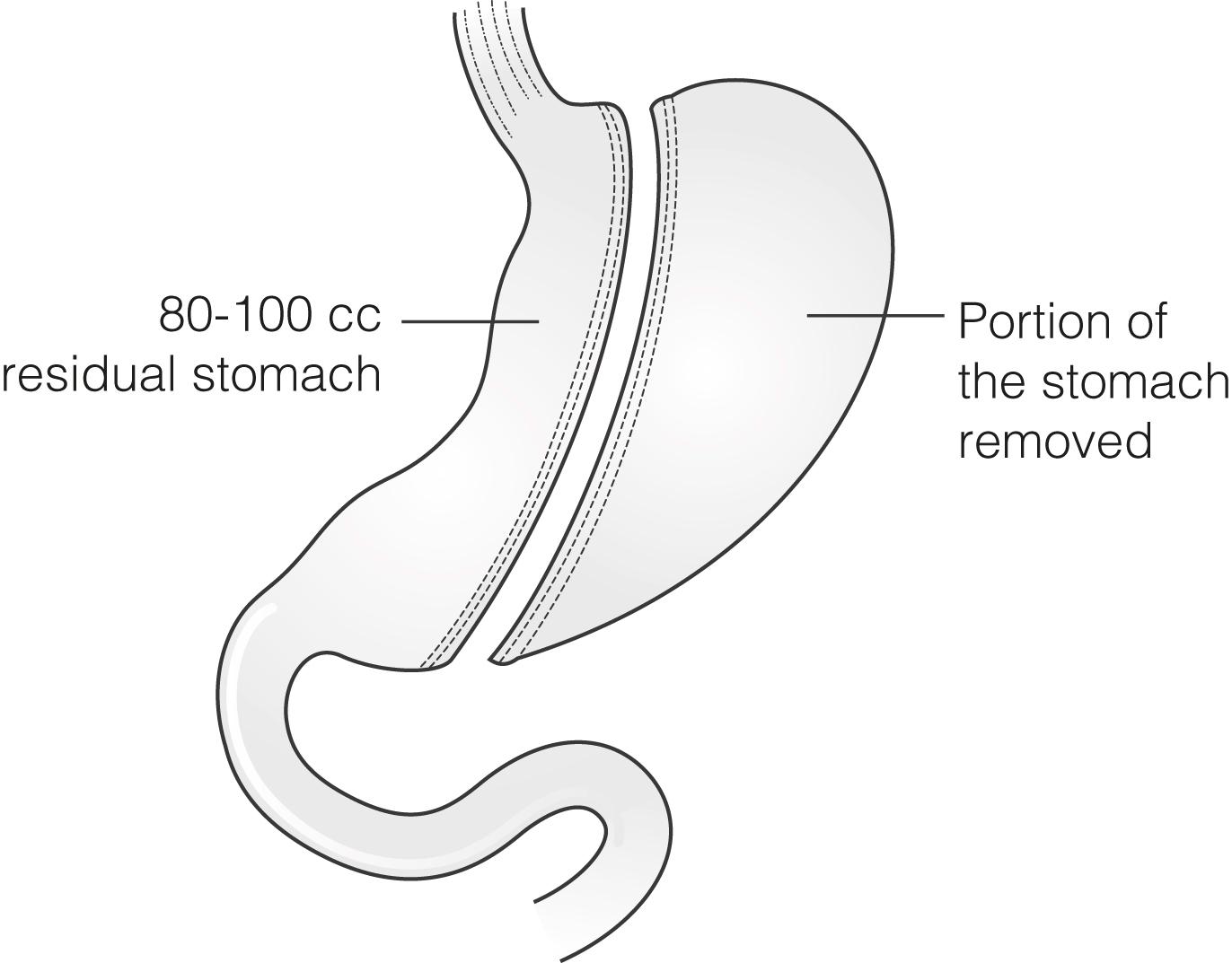 Figure 21.4, Diagram of sleeve gastrectomy. The omentum (not shown) is preserved on the gastro-epiploic arcade.