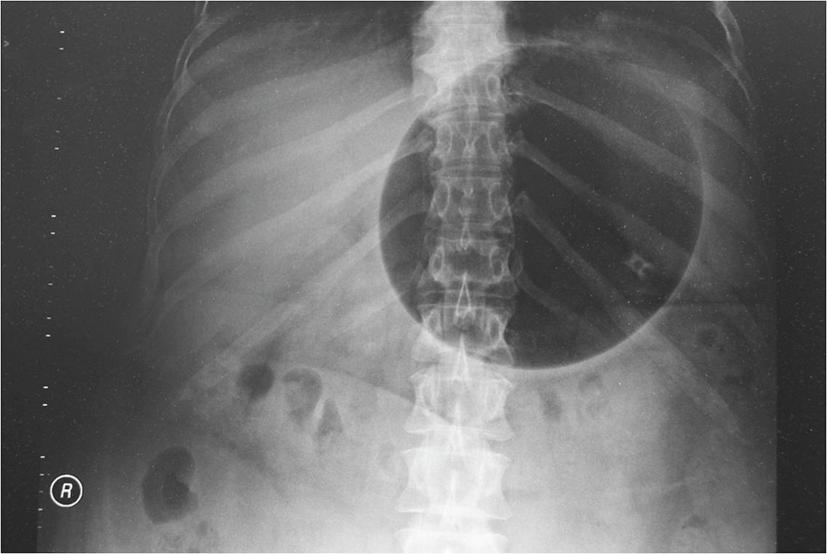 Figure 21.5, Abdominal X-ray of a patient with a gastric balloon in situ .