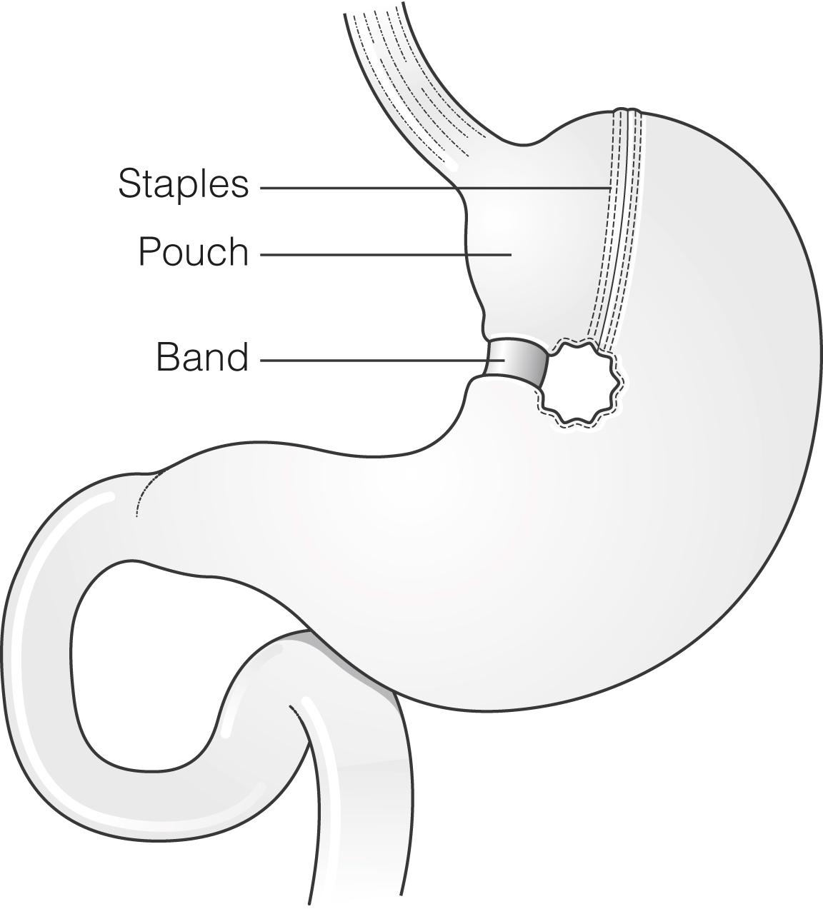 Figure 21.6, Diagram of the vertical banded gastroplasty procedure.