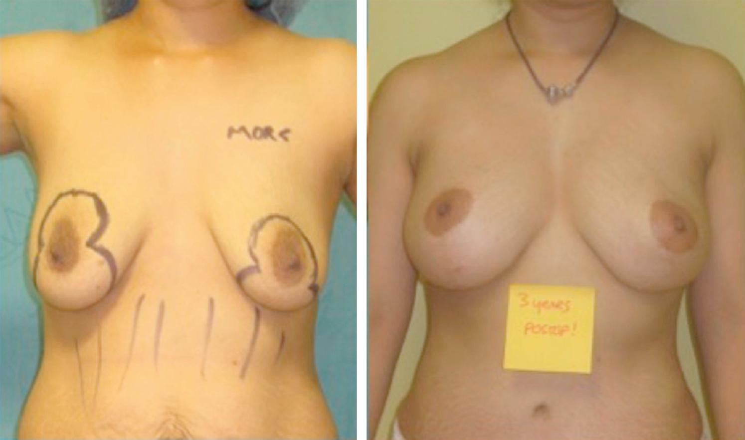 Fig. 7.6, Mastopexy combined with 400 cc fat shown at 3 years after surgery. To avoid ptosis, one may avoid an implant and use fat.